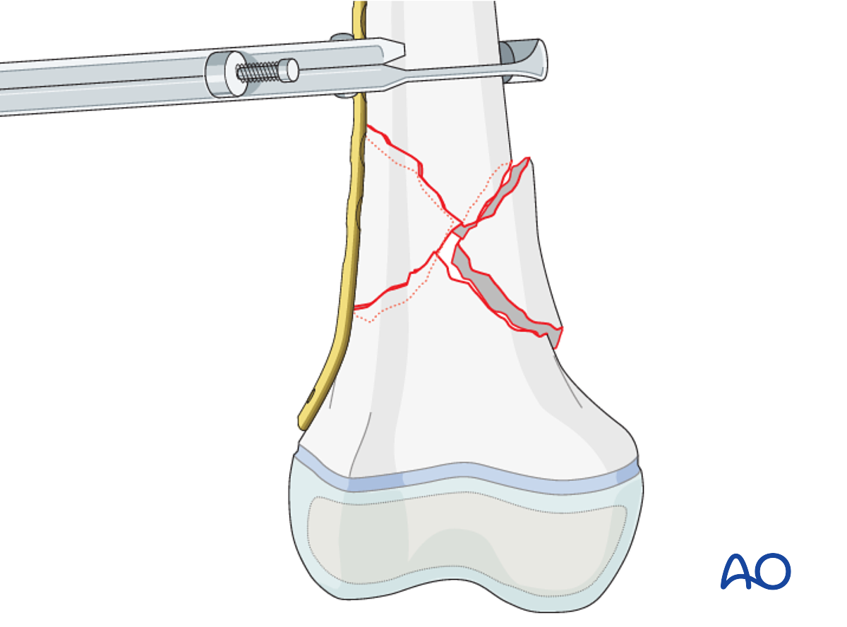 Open Reduction; Plate Fixation For Metaphyseal, Complete, Multifragmentary