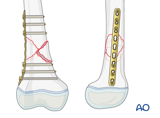 Fixation of a metaphyseal fracture of the distal femur with an LCP