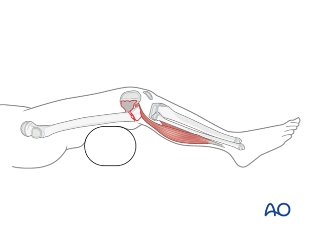 Bolster placed posterior to the fracture