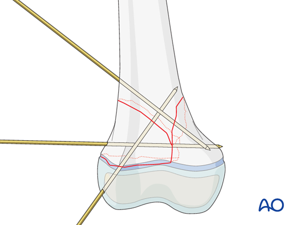 Temporary K-wire fixation