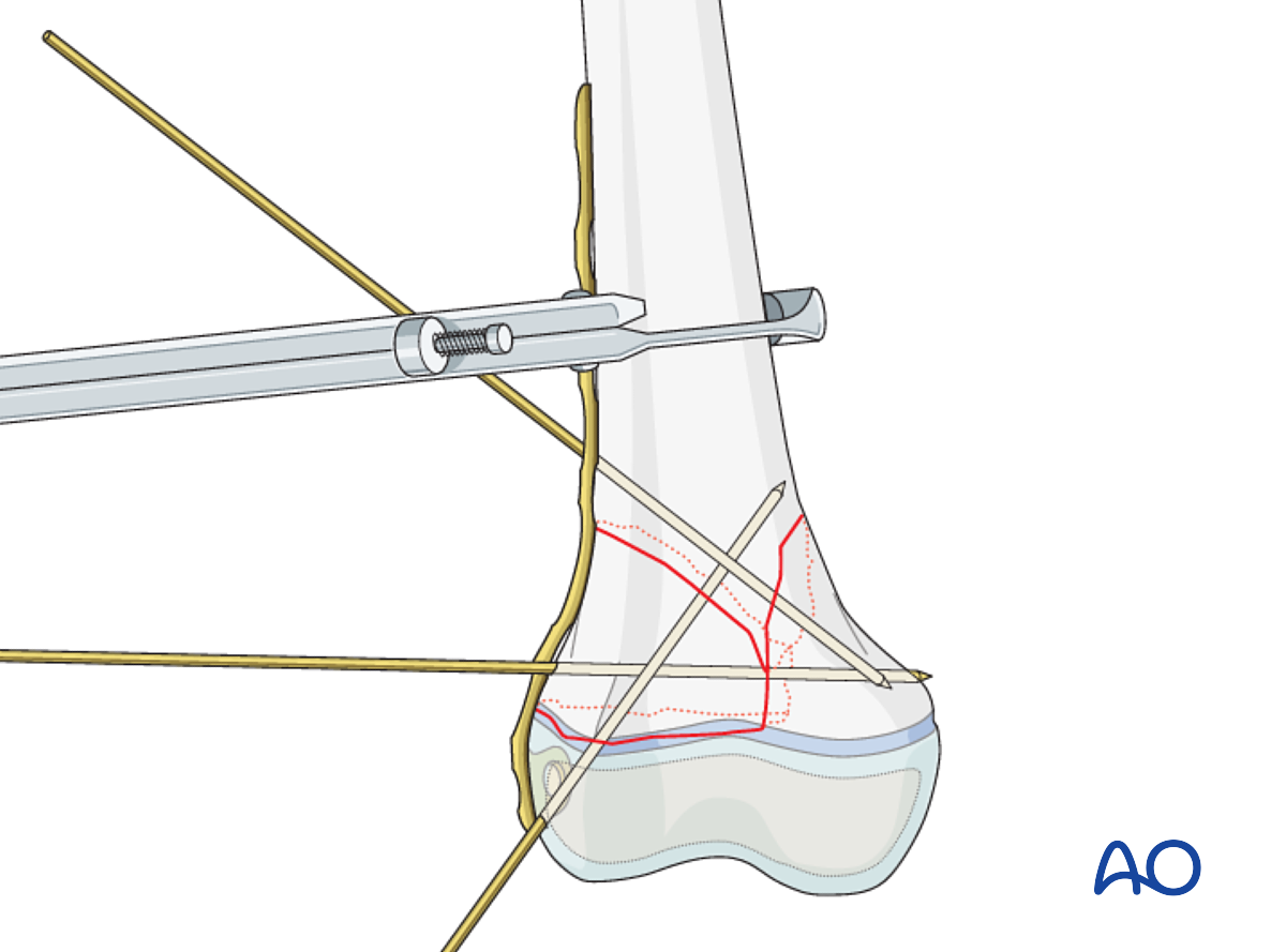 Open Reduction; Plate Fixation For Epiphysiolysis With Metaphyseal ...