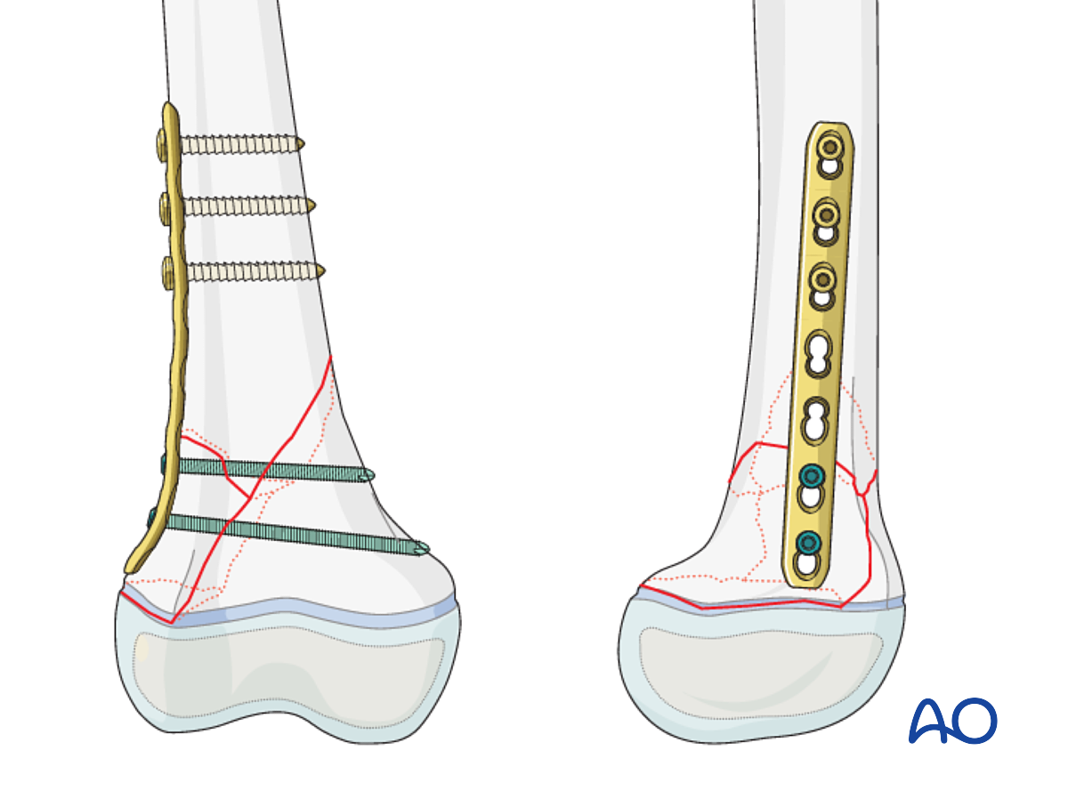 Open Reduction; Plate Fixation For Epiphysiolysis With Metaphyseal ...