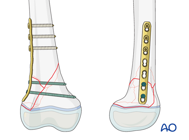 Plate fixation of a multifragmentary Salter-Harris II fracture of the distal femur