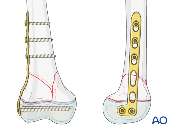 Plate fixation of a multifragmentary Salter-Harris II fracture of the distal femur