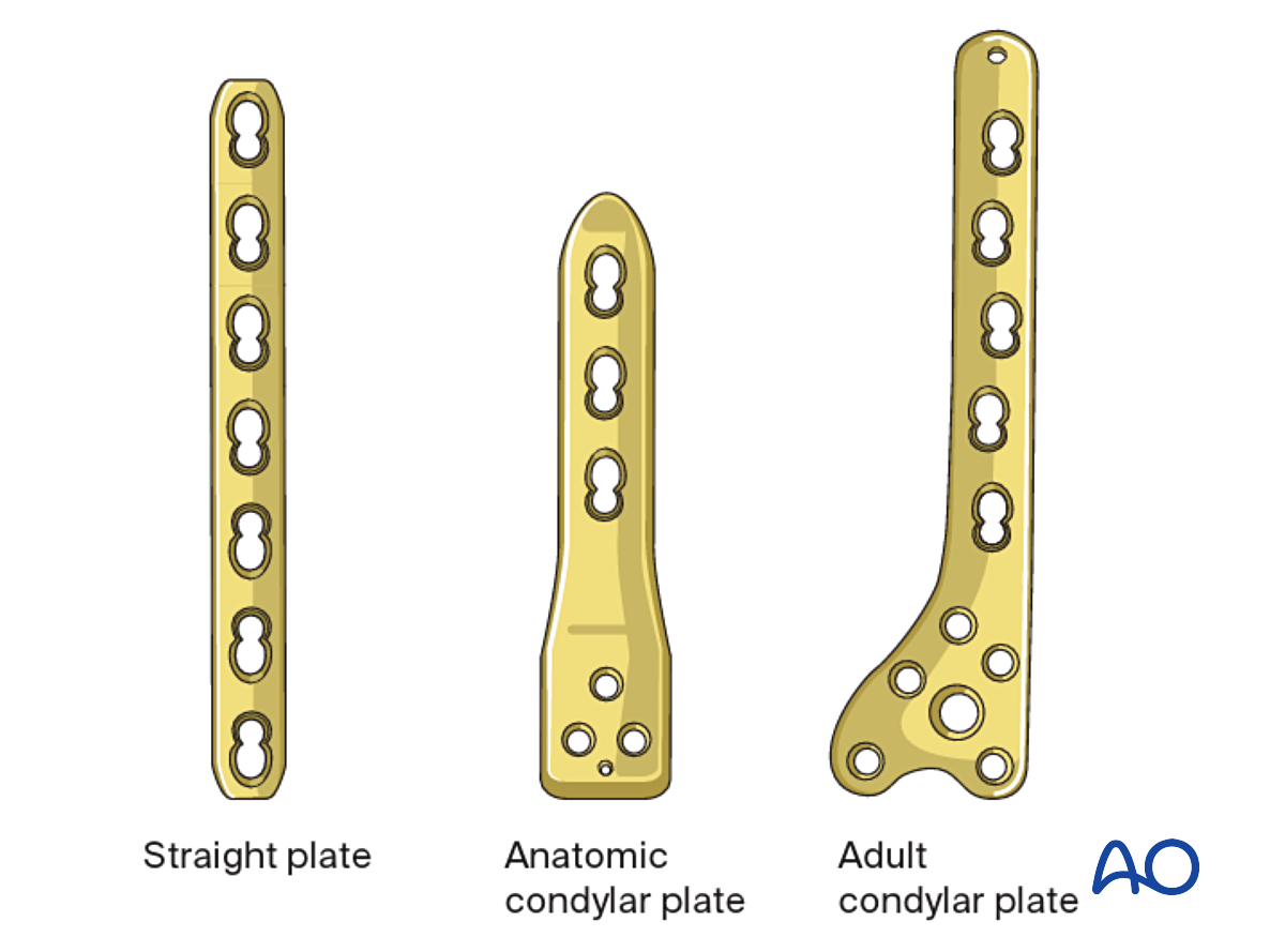 Open Reduction; Plate Fixation For Epi-/metaphyseal, Salter-Harris IV ...