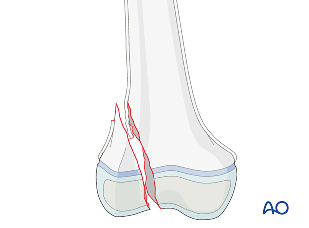 Interposed periosteum