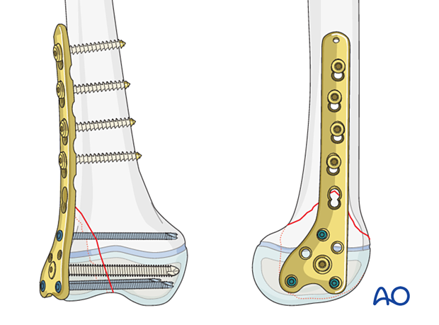 Final construct with an adult condylar plate