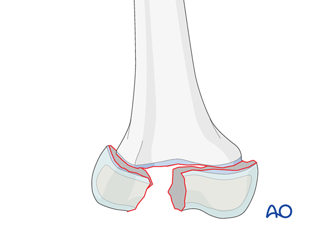 Displaced Salter-Harris III fracture