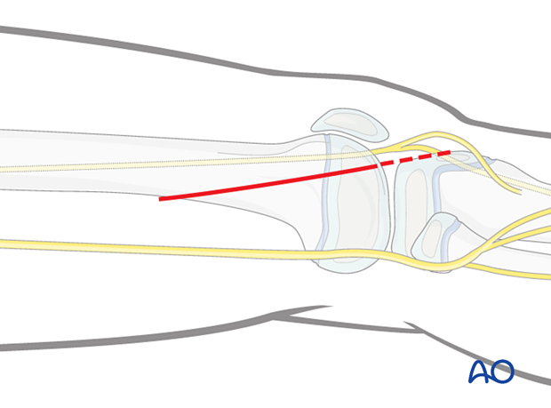 Open reduction through lateral approach