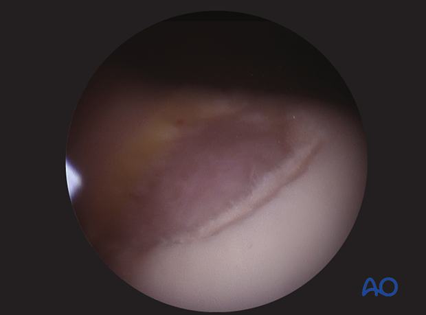 Intraoperative image of articular surface after excision
