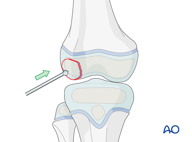 Reduction of the osteochondral fragment with a small ball-spike pusher