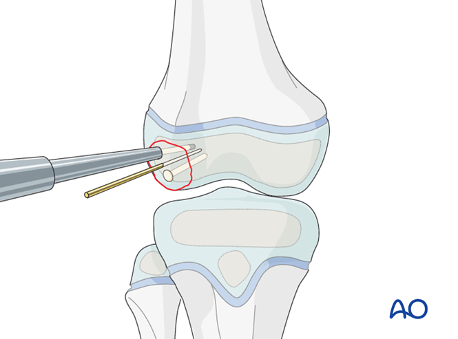 Open reduction; pin or screw fixation for Intraarticular flake