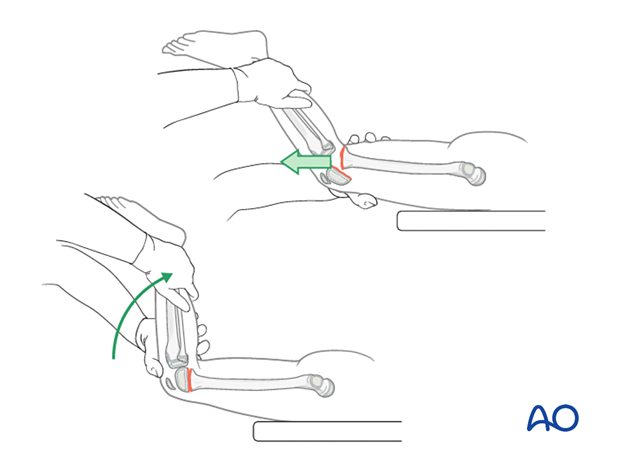 Prone patient positioning and reduction