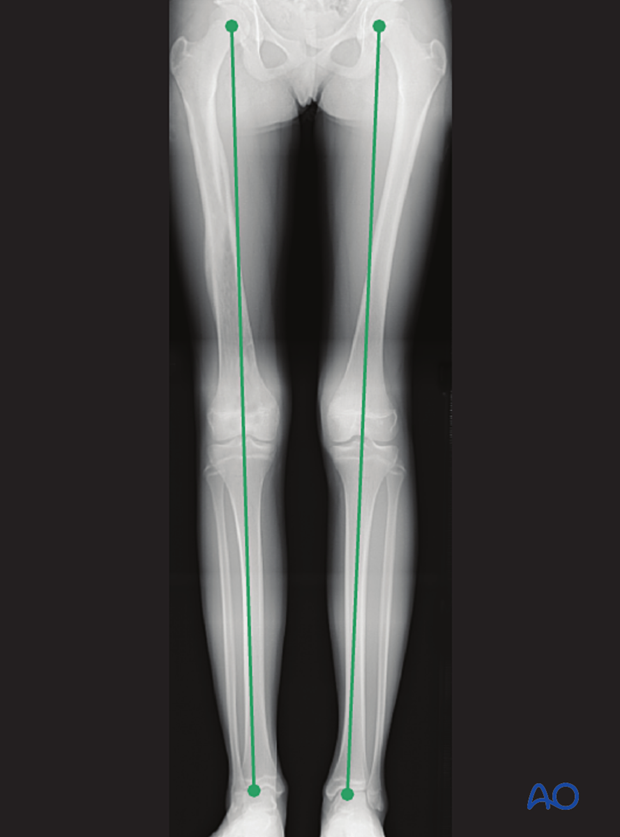Radiological assessment of leg length