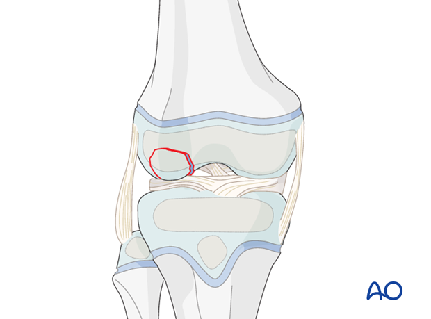 Injury of epiphyseal or articular cartilage