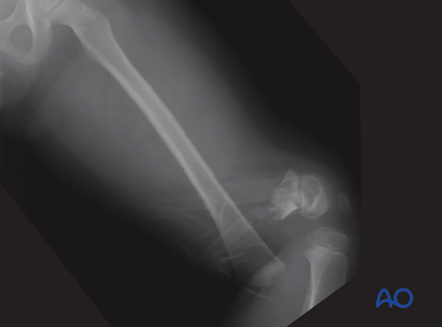 X-ray of a Salter-Harris II with significant anterior displacement and shortening