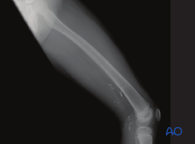 X-ray of a healed fracture with vascular clips