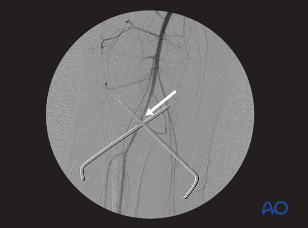 Angiogram following proximal tibial growth plate injury showing partial occlusion of the popliteal artery