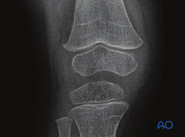 X-ray of the knee showing growth lines