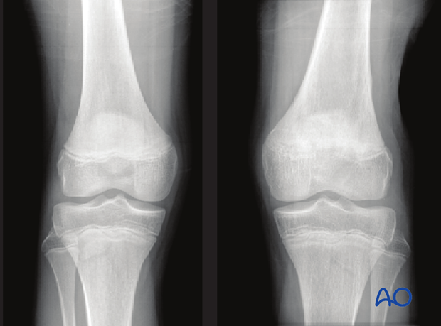 Unequal closing of the distal femoral physis