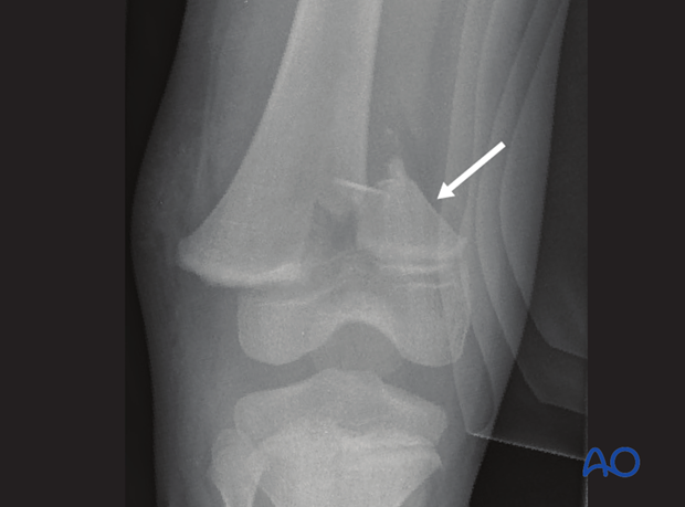 X-ray of a displaced Salter-Harris II fracture