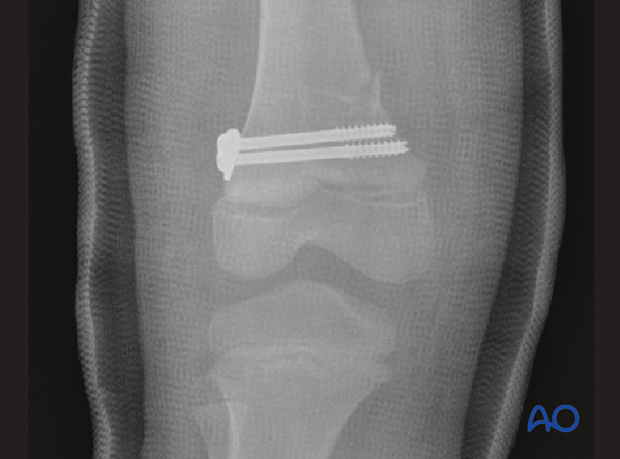 X-ray of a Salter-Harris II fracture stabilized with metaphyseal cannulated screws and protected in a cast
