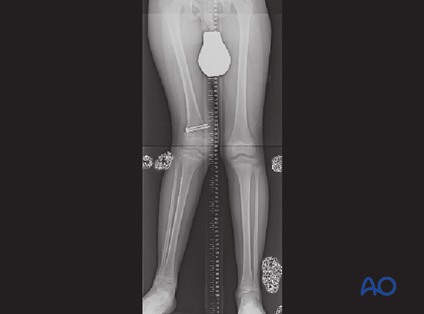 Standing x-ray showing significant shortening and deformity