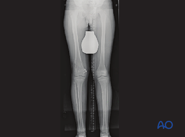 Standing x-ray showing gradual deformity correction with leg lengthening and completion of epiphysiodesis on the medial side