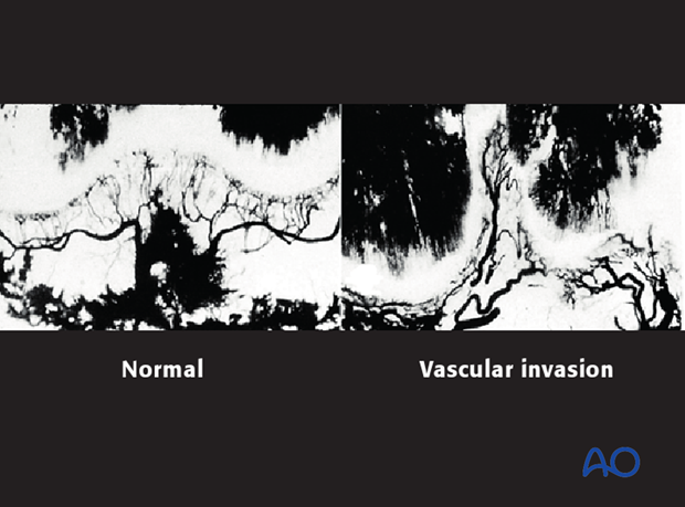 Vascular invasion into the fracture plane of a Salter-Harris IV injury