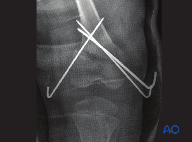 X-ray showing an incomplete reduction of a Salter-Harris II fracture stabilized with K-wires