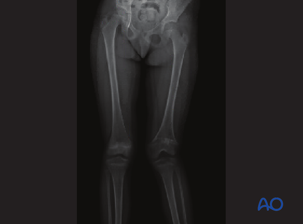 X-ray showing valgus deformity of the knee