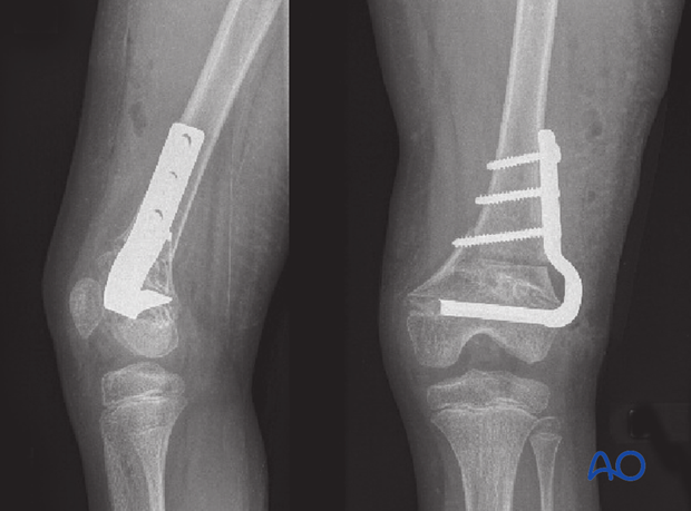X-ray of an osteotomy correcting the valgus deformity