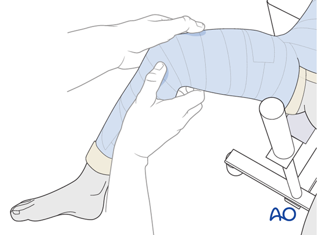Molding the thigh segment to maintain fracture reduction