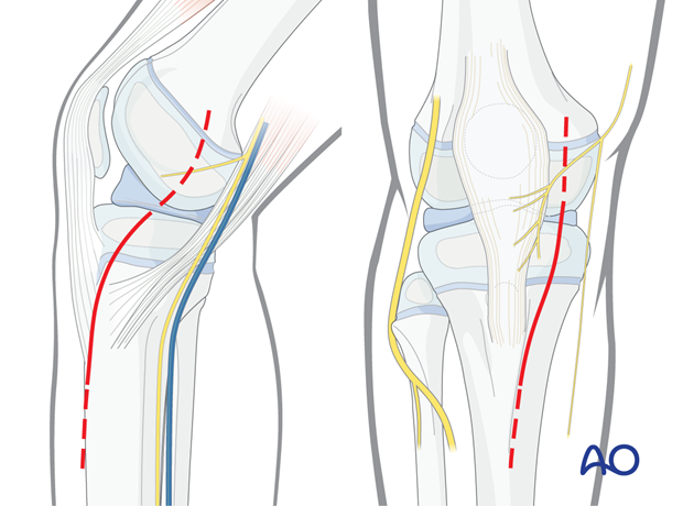 p41 A010 Medial parapatellar approach proximal tibia