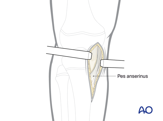 p41 A010 Medial parapatellar approach proximal tibia