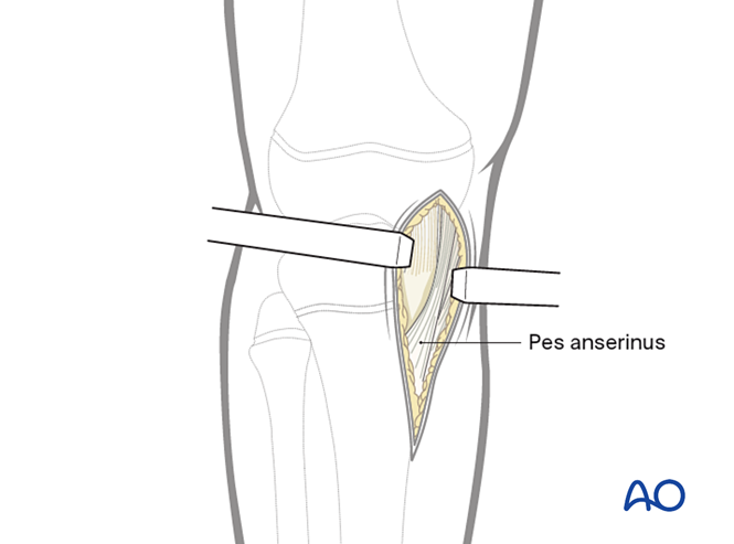 Medial parapatellar approach to the proximal tibia