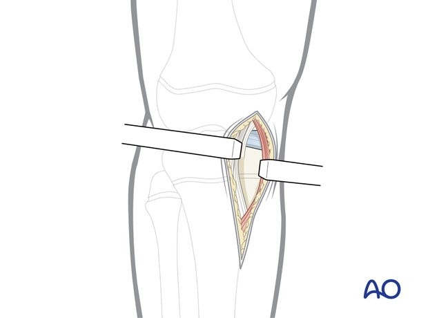 p41 A010 Medial parapatellar approach proximal tibia