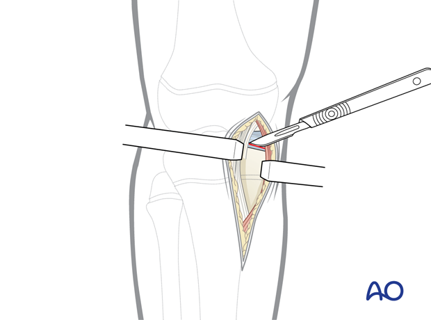 p41 A010 Medial parapatellar approach proximal tibia