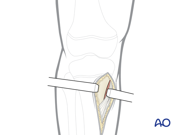 p41 A010 Medial parapatellar approach proximal tibia