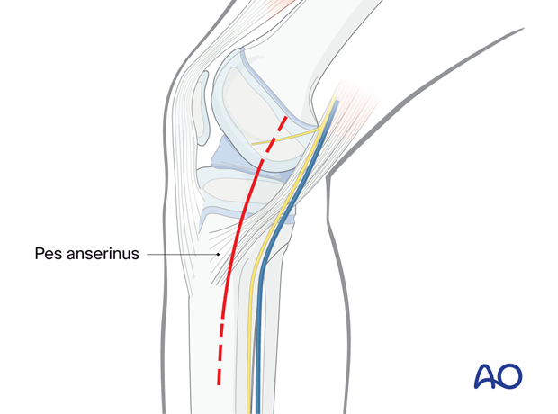 Incision of a medial approach to the proximal tibia