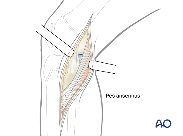 p41 A020 Medial approach proximal tibia