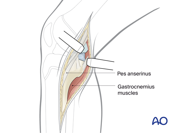 p41 A020 Medial approach proximal tibia