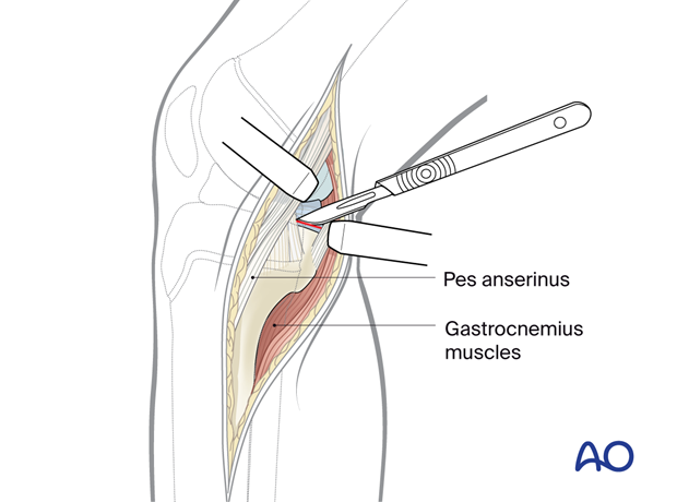 p41 A020 Medial approach proximal tibia