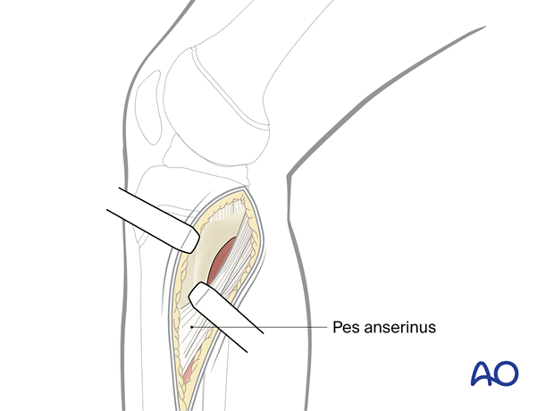 p41 A020 Medial approach proximal tibia