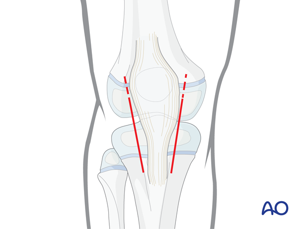 Skin incision, lower pole of the patella, exposure of the articular surface