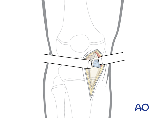 Incise the capsule, knee capsule is incised