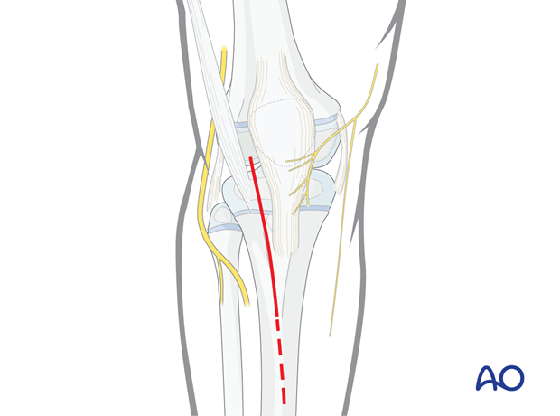 Incision of an Anterolateral approach to the proximal tibia