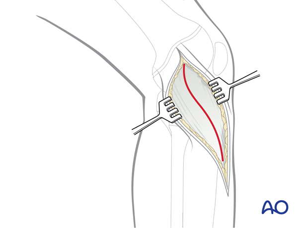 Deep fascia leaving sufficient attachment to the bone anteriorly