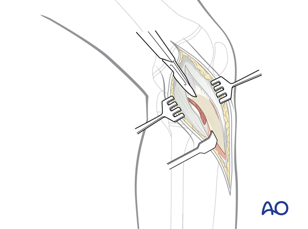 Proximal attachment of the tibialis anterior. Avoid the peroneal nerve.