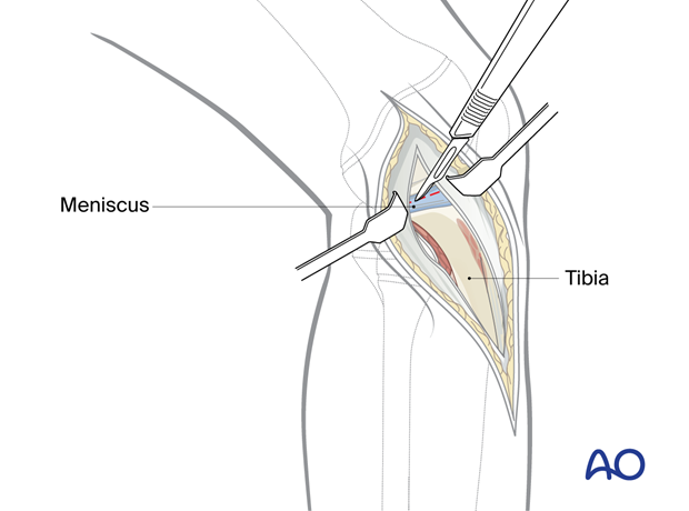 Expose the joint, incise the capsule horizontally